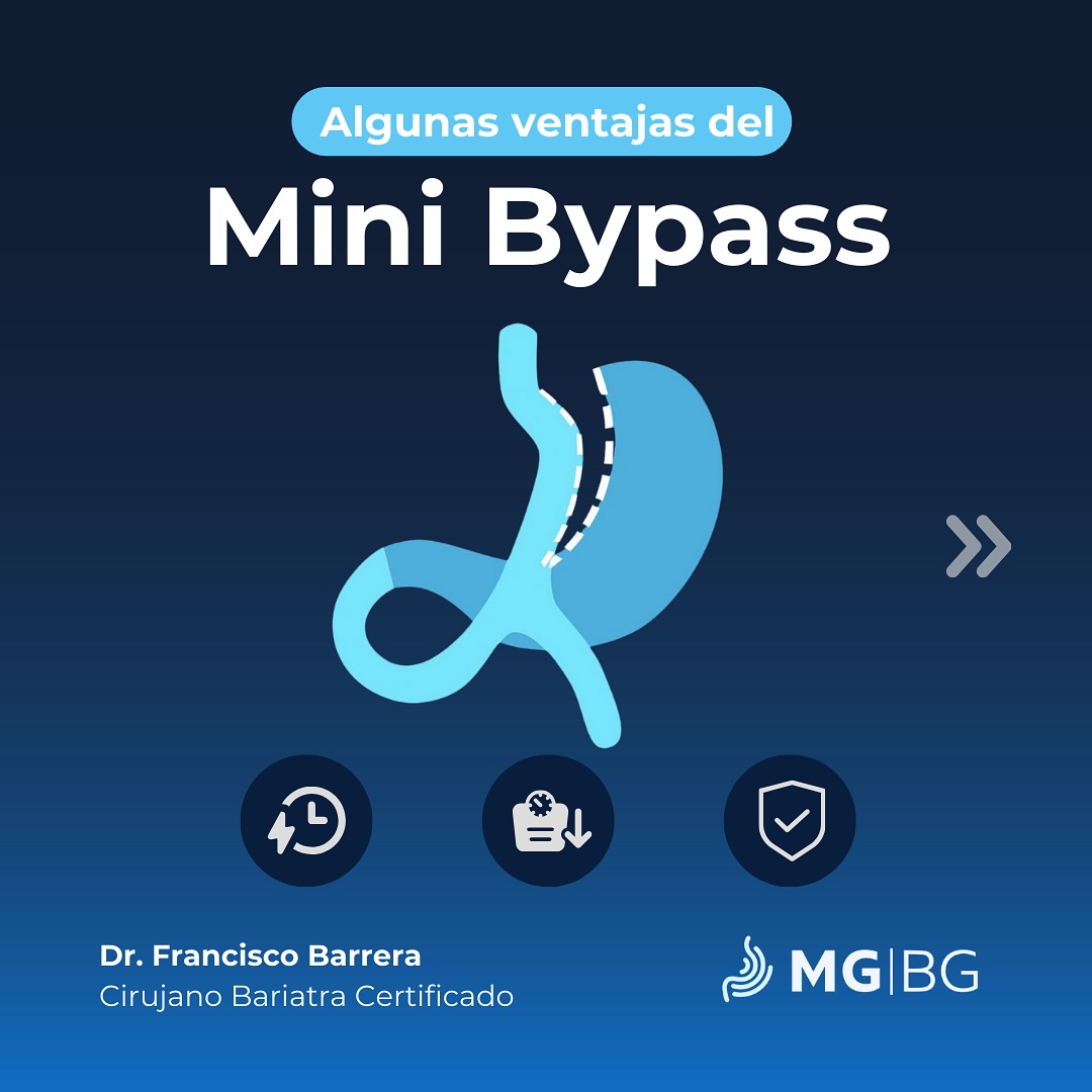 Mini Bypass Gástrico