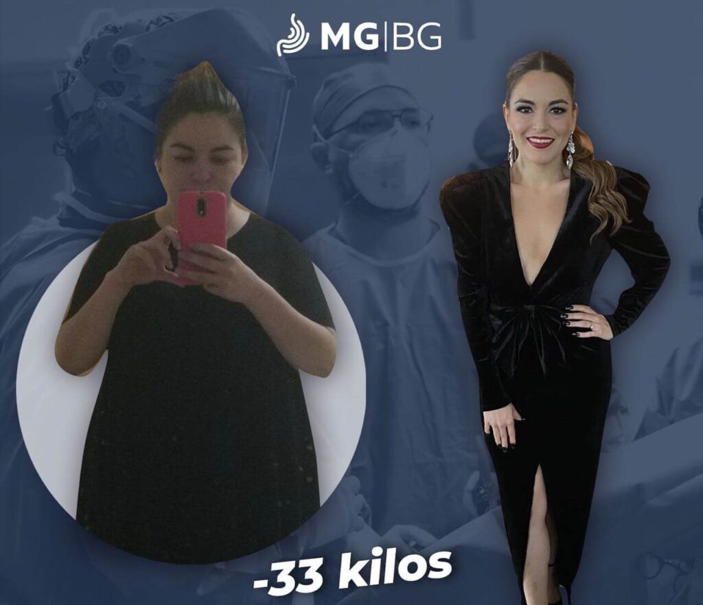 Antes y Después, Cirujano Bariatra, Bariatras en Monterrey, Bariátrico