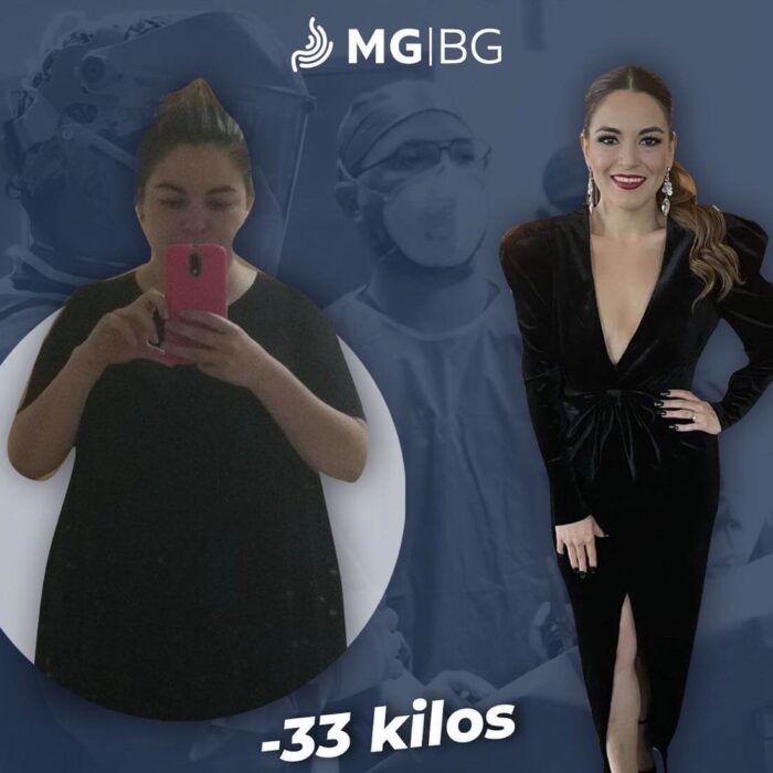 Antes y Después, Cirujano Bariatra, Bariatras en Monterrey, Bariátrico