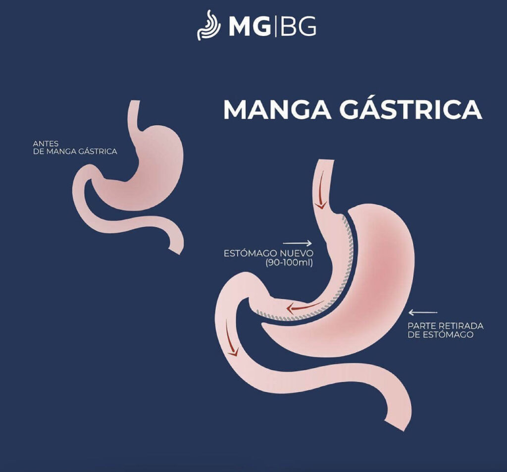 Manga gástrica, Manga gástrica precio, precio manga gástrica, Cuanto cuesta una manga gástrica, Manga gástrica costos, Manga gástrica que es, Que es manga gástrica, Que es una manga gástrica, Cirugía manga gástrica, Cirugía de manga gástrica, Operación manga gástrica, Manga gástrica Monterrey, cirugia de manga gastrica en mexico, cuanto cuesta la manga gastrica en mexico, precio de manga gastrica en mexico, costo de la manga gastrica en mexico, cirugia para bajar de peso, cirugia de obesidad, operacion para adelgazar, operacion de estomago, reduccion de estomago, operaciones para bajar de peso, perdida de peso.