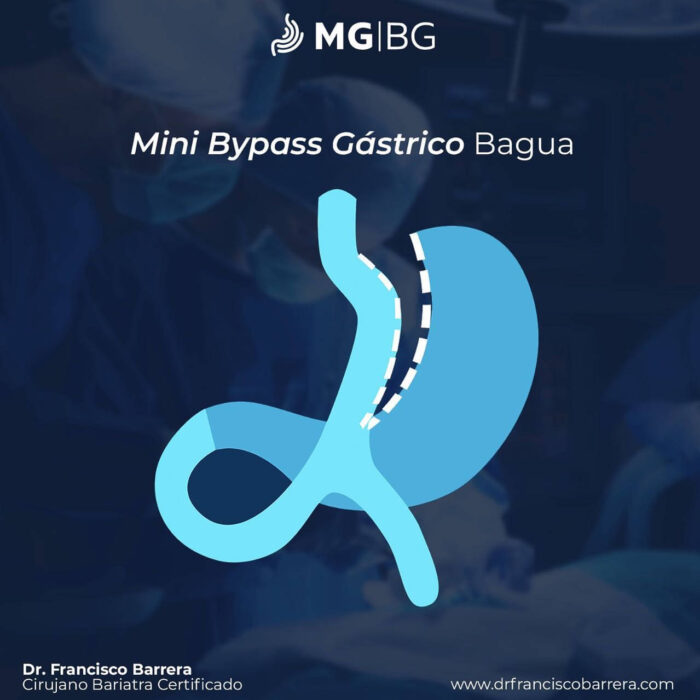 Mini Bypass Gástrico Monterrey Bariatras En Monterrey 7575