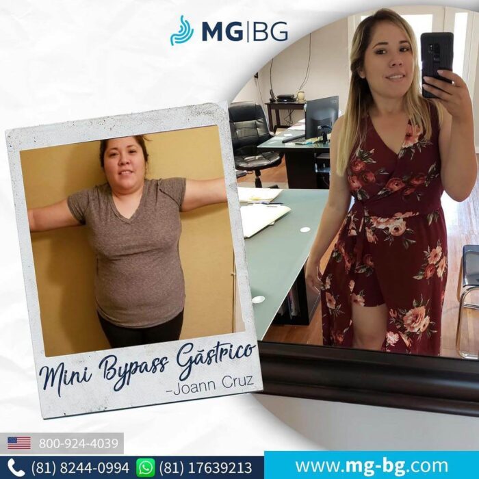 Mini Bypass Gástrico Monterrey, Mini gastric bypass, Mini bypas gástrico precio, Mini bypass gástrico costo, Que es un mini bypass, Mini bypass gastric